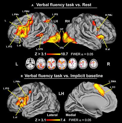 Unique Neural Characteristics of Atypical Lateralization of Language in Healthy Individuals